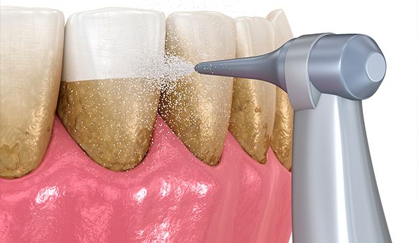 Dental cleaning process showing a dental tool spraying water on teeth with some plaque buildup demonstrating the importance of regular cleaning for gum health and prevention of dental issues 5 star dental care techniques