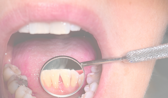 a dental mirror showing the back of the lower teeth with no plaque, calculus or staining